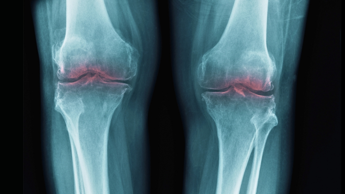 Health ScienceAlert New Breakthrough to Restore Aging Joints Could Help Treat Osteoarthritis